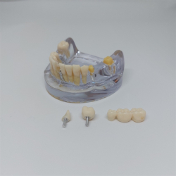 Implantat/Bro Studiemodel 